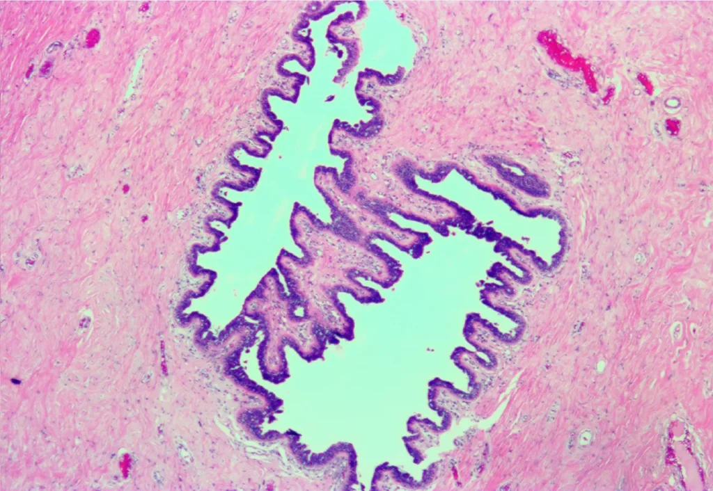 Męski gruczoł piersiowy z widocznym zwłóknieniem zrębu, obraz mikroskopowy.
