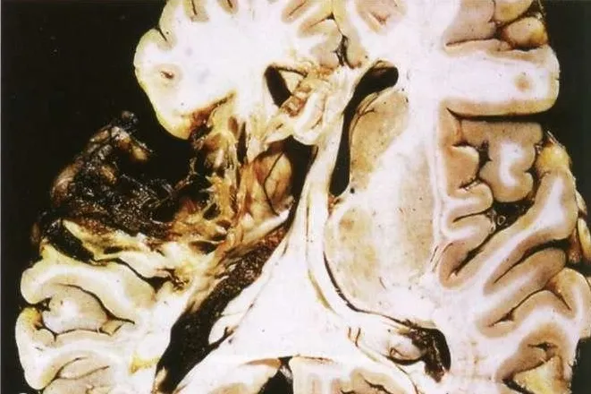 Mózg z lożą, która powstała na skutek przebytego zawału (udaru) mózgu.