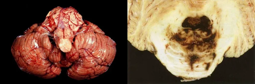 Preparat makroskopowy przedstawiający skutki wgłobienia migdałków móżdżku w otwór wielki czaszki.
