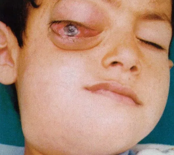 Zdjęcie dziecka z guzem nowotworowym - chłoniakiem w obrębie oczodołu i żuchwy.