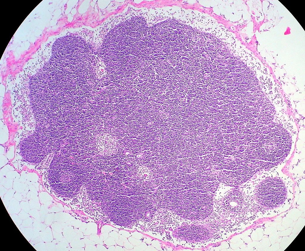 Preparat histologiczny węzła chłonnego. Śmierć wywodząca się z układu limfatycznego dotyczy chłoniaka Burkitta.