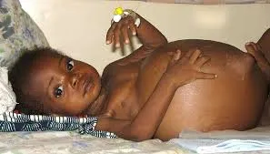 Zdjęcie dziecka z śmiertelnym chłoniakiem Burkitta.