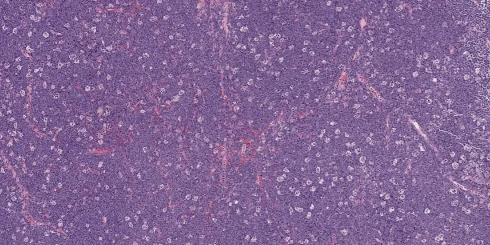 Preparat histopatologiczny węzła chłonnego przedstawiający objaw gwiaździstego nieba. Typowy widok dla śmiercionośnego Chłoniaka Burkitta