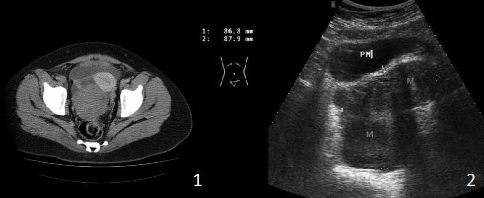 Obraz radiologiczny TK przedstawiający objaw masy.
