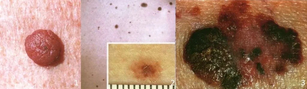 Zdjęcia znamion barwnikowych i cechy odróżniające je od znamion dysplastycznych oraz melanoma malignum.