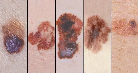 Zdjęcie przedstawia kolejne cechy czerniaka z algorytmu ABCD i E.