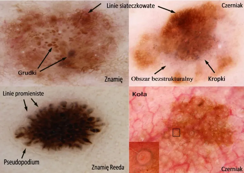 Obrazy uzyskane w dermatoskopii ukazują cechy wzbudzające niepokój onkologiczny.