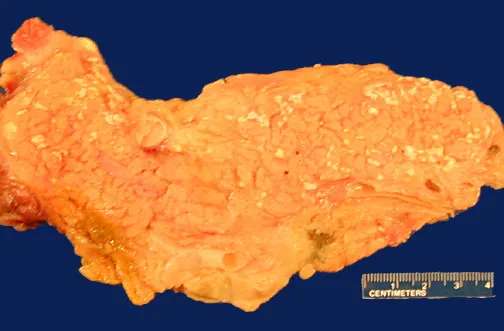 Preparat makroskopowy trzustki z obecnością martwicy enzymatycznej tkanki tłuszczowej. Skutek picia alkoholu.