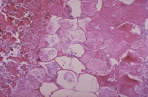 Obraz histopatologiczny zapalenia trzustki. Uwidoczniono obszary martwicy tłuszczowej.