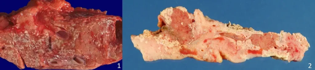 Preparat makroskopowy trzustki z obecnością zarówno martwicy enzymatycznej tkanki tłuszczowej jak i ogniskami krwotocznymi.