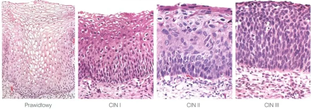 Wenery, choroby jak HPV przyczyniają się do raka. Widzimy obrazy mikroskopowe, przedstawiające rozwój dysplazji szyjki macicy.