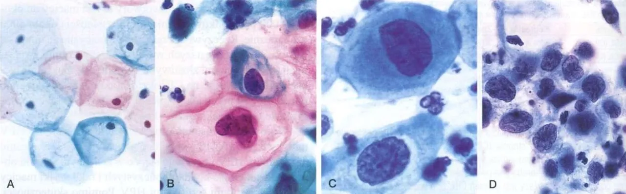 Rozmazy cytologiczne próbek pobranych z tarczy szyjki macicy. Badanie to znajduje zastosowanie w diagnostyce HPV, które przenoszone jest drogą weneryczną.
