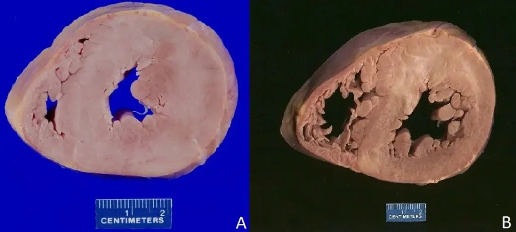 Serce z przerostem lewej komory.