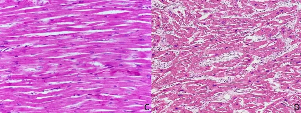 Obraz mikroskopowy mięśnia sercowego z uwidocznionym przerostem.