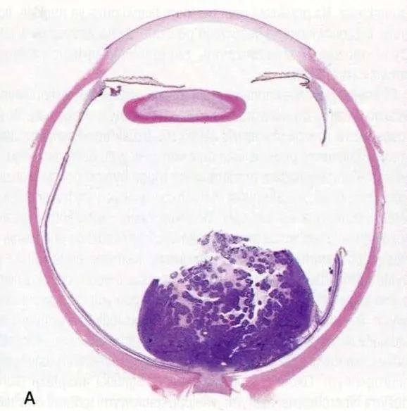 Preparat mikroskopowy oka z uwidocznionymi komórkami retinoblastomy.