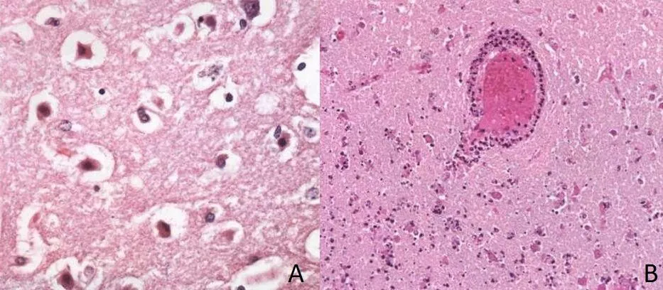Preparat mikroskopowy przedstawiający nieodwracalne zmiany w mózgu na skutek niedotlenienia - udar, "żniwiarz neuronów".