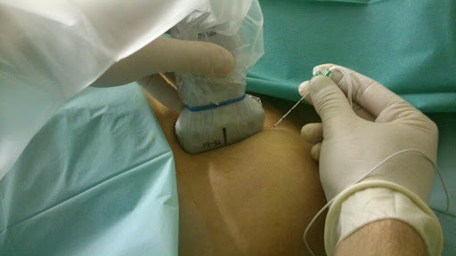 Blokada bólowa splotu ramiennego.