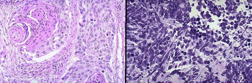 Złap raka - rak płaskonabłonkowy płuca oraz rak drobnokomórkowy.