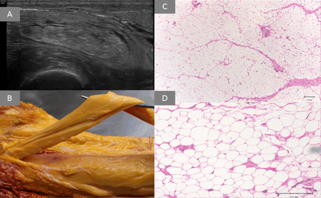 Sarkopenia. Trzeci stopień zwyrodnienia mięśnia. Widok USG, preparat pośmiertny oraz histologiczny.