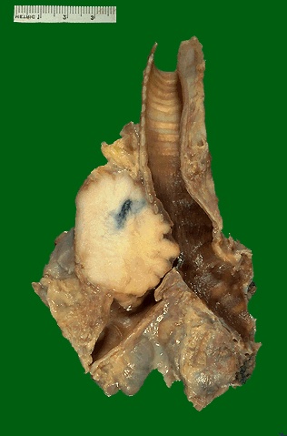 Złap raka: preparat makroskopowy - przekrój poprzeczny przez guza odoskrzelowego.