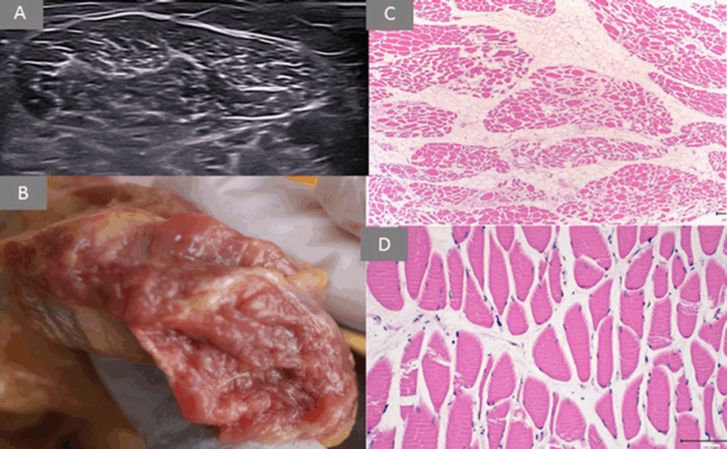 Sarkopenia. Drugi stopień zwyrodnienia mięśnia. Widok USG, preparat pośmiertny oraz histologiczny.