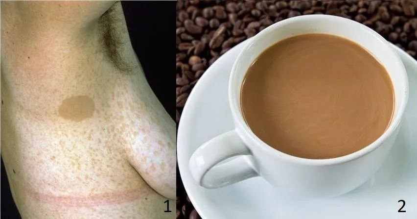 Zmiana typu cafe au lait - kawa z mlekiem. Może wskazywać na dysplazje włóknistą kości czy nerwiakowłókniakowatość typu 1.