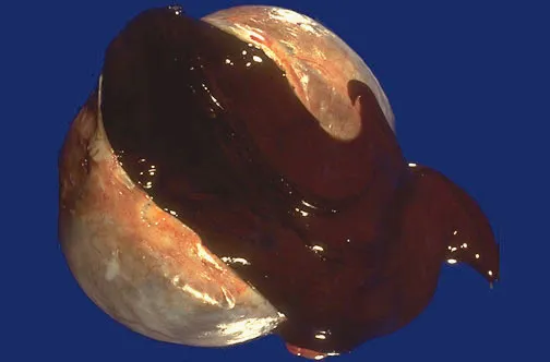 Torbiel czekoladowa jajnika, często w przebiegu endometriozy.