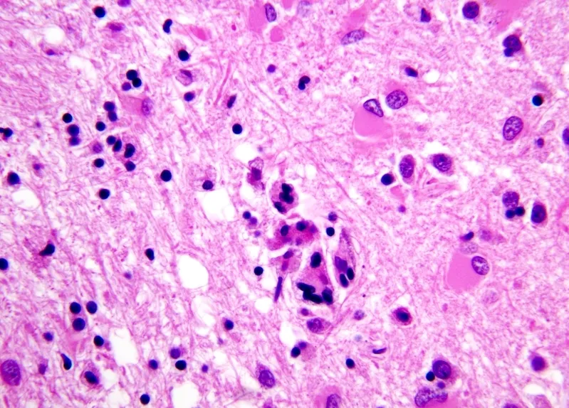 Profilaktyka HIV, na zdjęciu widać mikroglej po kontakcie z wirusem HIV. Obraz wskazuje na encefalopatię powodowaną przez HIV.