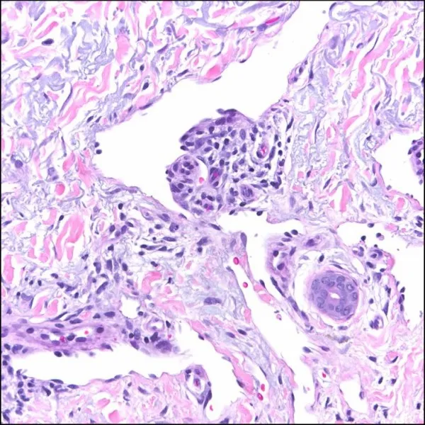 Konsekwencje HIV. Infekcja HHV-8 dająca mięsaka Kaposiego.