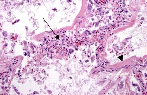 Tlen i jego toksyczne właściwości mogą prowadzić do rozwoju ARDS