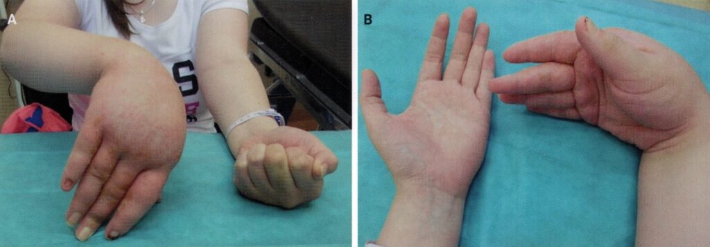 Przeciążenie nadgarstka. Blokada regionalna skutecznym pomostem leczenia zespołu Sudecka