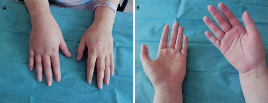 Przeciążenie nadgarstka. Blokada regionalna skutecznym pomostem leczenia zespołu Sudecka.