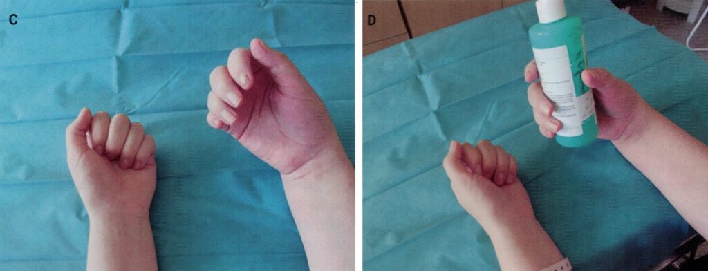 Przeciążenie nadgarstka. Blokada regionalna skutecznym pomostem leczenia zespołu Sudecka